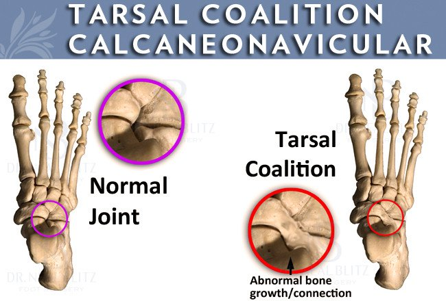 Tarsal coalition